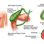 показания к удалению желчного пузыря