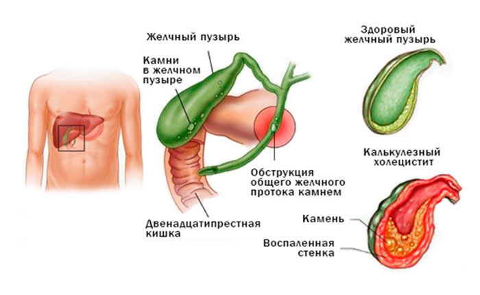 Объективные показания к удалению желчного пузыря