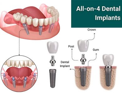 Імплантація зубів All-on-4 – рішення для нової усмішки