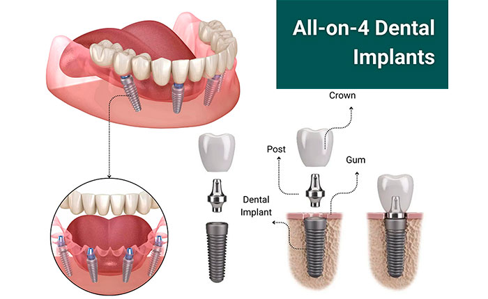 Імплантація зубів All-on-4 – рішення для нової усмішки